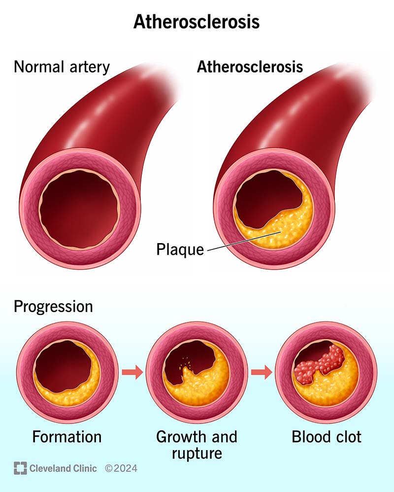 Atherosclerosis And Hypertension Worksheet Live Worksheets