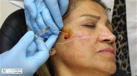 Cheek Preauricular Area And Tear Trough Fillers Dr Noury Adel Youtube