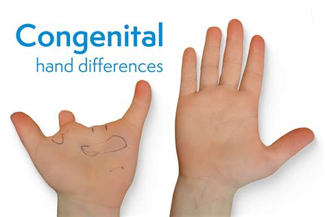 Congenital Hand Differences