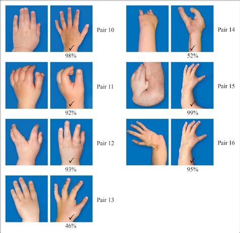 Figure 1 From Factors Affecting Hand Cosmesis And The Aesthetic Impact Of Surgery On Congenital