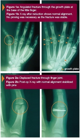 Hand And Wrist Fractures In Children Orthopedic Surgeons Hand Specialists For Children In