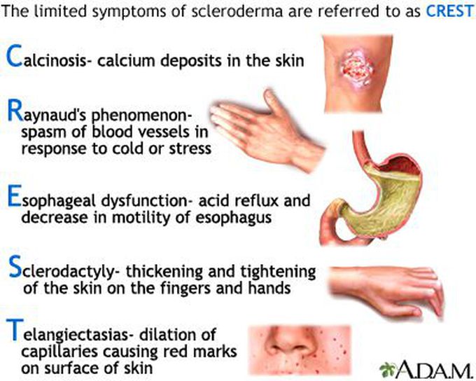 Internal Organs Of Our Body Images Morphea Scleroderma Elecrisric