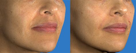 Juvederm Fillers Face Before After Dermmedica