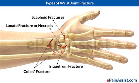 Pdf Common Wrist And Hand Fractures Allied Health Education Common Wrist And Hand