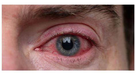 Pepper Spray Effects On Eyes