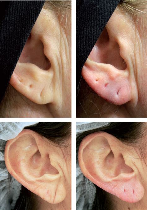 5 Tips Preauricular Filler