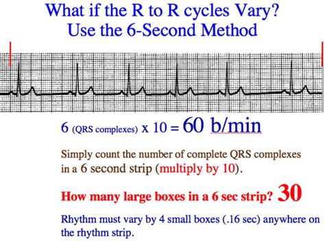 Triplets R To R 6 Second Heart Rate Method